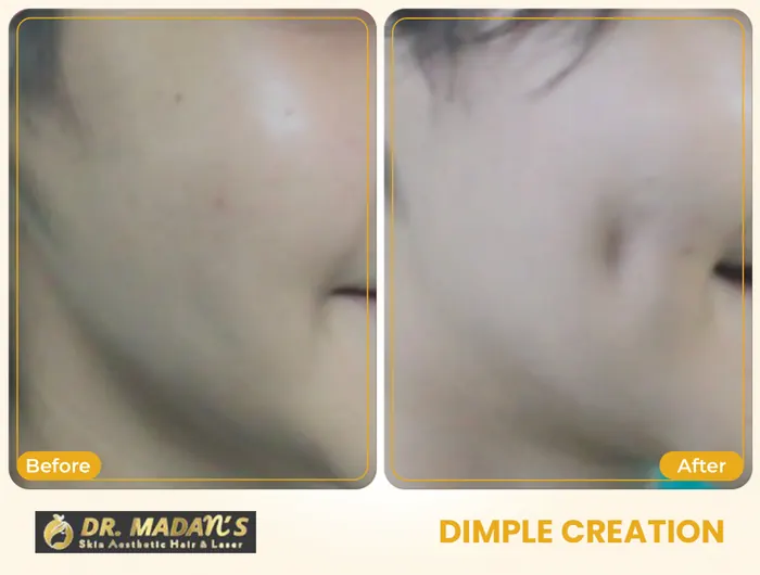 Dimple creation before and after result 1 at Dr Madan Aesthetics